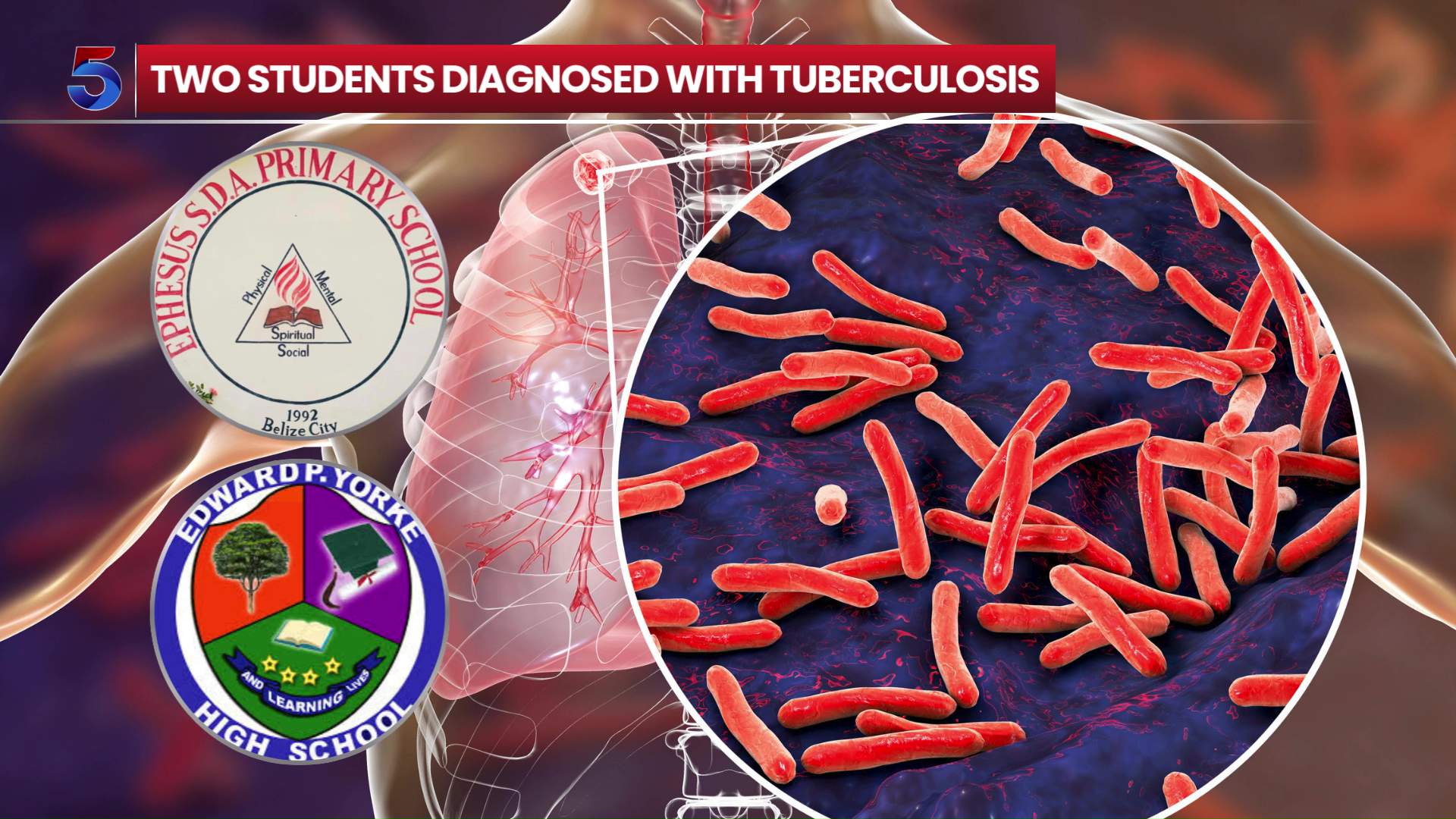 Two Students Diagnosed With Tuberculosis